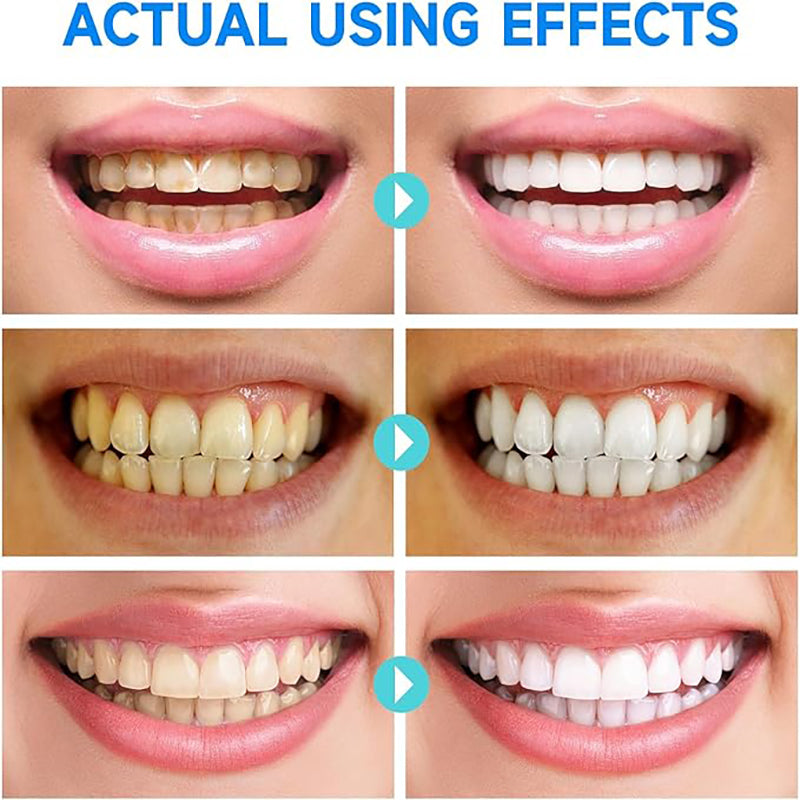 BrightWhite -  Whiter Teeth in Just 10 Seconds!